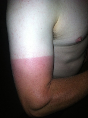 This is what a biker's burn looks like. 